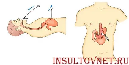 Disfagia în accident vascular cerebral cum să facă față problemei