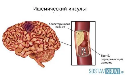 Нарушение на мозъчното кръвообращение причинява симптомите, лечение, рехабилитация