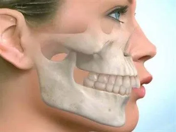 Malocluzie (maxilarului superior înainte), de asemenea, cunoscut sub numele de ocluzie distală