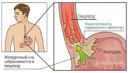 Elégtelensége a cardia a gyomor (cardia sphincter), hogy