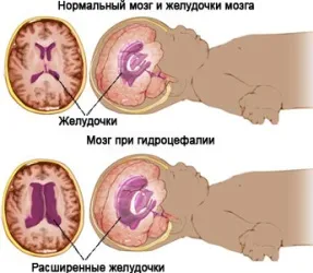 Все про водянці головного мозку діагностика, симптоми і лікування (лікування) Все про водянці головного мозку діагностика, симптоми і лікування