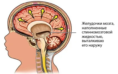 Все про водянці головного мозку діагностика, симптоми і лікування (водянки головного мозку) Все про водянці головного мозку діагностика, симптоми і лікування