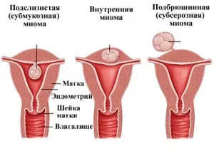 Descriere macropreparations miomul uterin