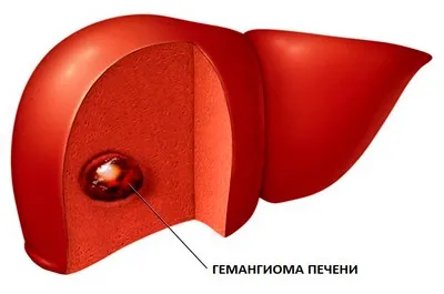 Májdaganat - haemangioma (kód szerinti BNO-10, UH, CT, MRI), orvosi folyóiratban „fiatal orvos”