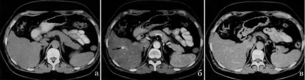 Májdaganat - haemangioma (kód szerinti BNO-10, UH, CT, MRI), orvosi folyóiratban „fiatal orvos”