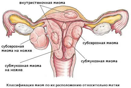Descriere macropreparations miomul uterin