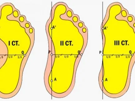 pantofi ortopedice pentru picioare plate la adulti, ceea ce sa poarte femei