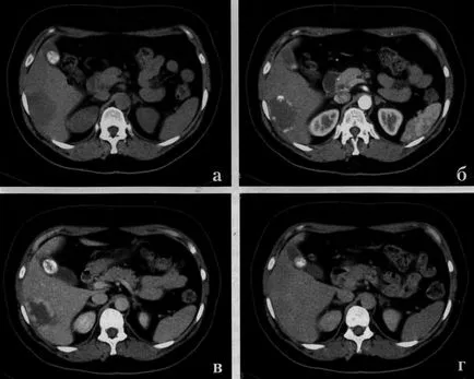 Májdaganat - haemangioma (kód szerinti BNO-10, UH, CT, MRI), orvosi folyóiratban „fiatal orvos”