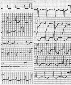 Acută subendocardică descriere infarct miocardic a bolii, simptome, recomandările de tratament