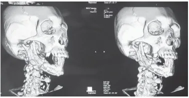 Caracteristici bifosfonati osteonecroză maxilară