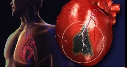 Cauzele acute subendocardiace infarct miocardic si dezvoltarea simptomelor