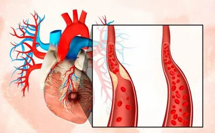 Cauzele acute subendocardiace infarct miocardic si dezvoltarea simptomelor