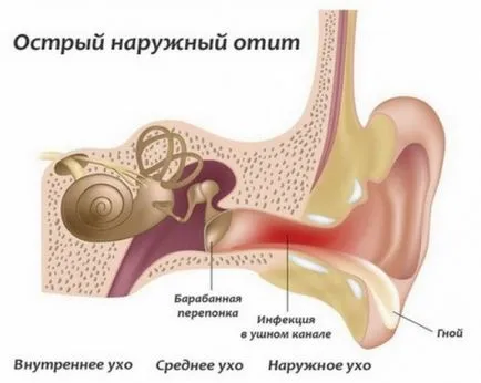 Otita medie - că este simptomele, cauzele si tratamentul