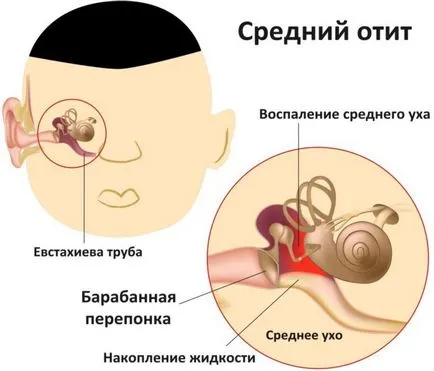 Отит на средното ухо симптоми, причини, лечение, диагностика, консултации