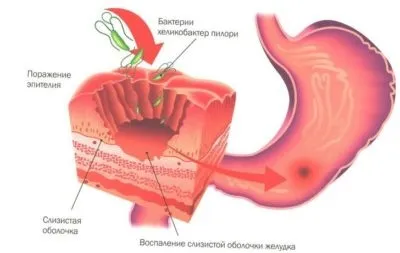 Хронічний Бульби причини, симптоми, форми, лікування