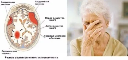 Хронічна ішемія головного мозку причини, симптоми, стадії, діагностика, лікування (головного) Хронічна ішемія головного мозку причини, симптоми, стадії, діагностика, лікування