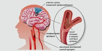 Хронічна ішемія головного мозку причини, симптоми, стадії, діагностика, лікування (мозку) Хронічна ішемія головного мозку причини, симптоми, стадії, діагностика, лікування