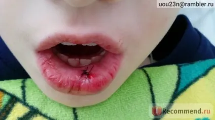 Хірургічне видалення ретенционной кісти нижньої губи - «ретенційна кіста нижньої губи, наш досвід (кіста) Хірургічне видалення ретенционной кісти нижньої губи - «ретенційна кіста нижньої губи, наш досвід