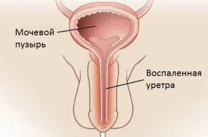 Хламідіоз причини захворювання і наслідки для чоловіків і жінок (наслідки) Хламідіоз причини захворювання і наслідки для чоловіків і жінок
