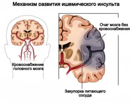 Хронічна ішемія головного мозку причини, симптоми, стадії, діагностика, лікування (головного) Хронічна ішемія головного мозку причини, симптоми, стадії, діагностика, лікування