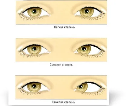 Характеристика сходиться косоокості, про хвороби очей (косоокість) Характеристика сходиться косоокості, про хвороби очей
