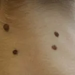 Папіломи у собак (папіломи) Папіломи у собак