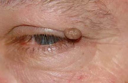 Папиломен за окото причинява, лечение, как да се премахне като у дома си