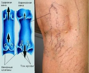 Peroxidul de hidrogen de la comentarii varicoase și consiliere cu privire la cerere