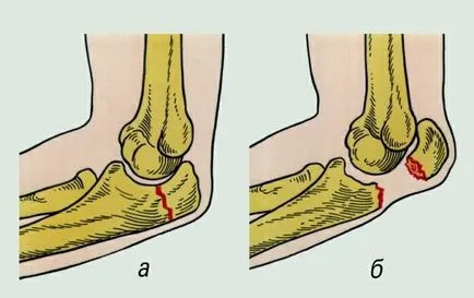 Fractura simptomele comune cot si tratament, exercitii fizice, reabilitare