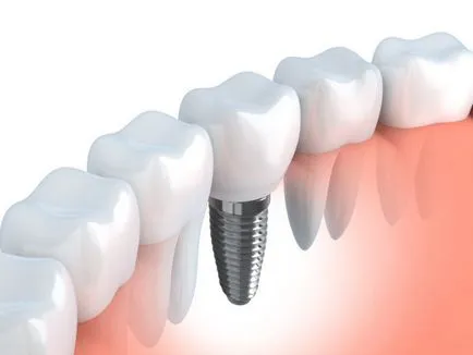 Periimplantitis - Simptome si tratament