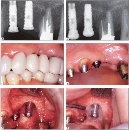 simptome Periimplantit, fotografie, tratament
