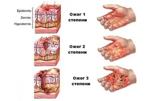 Elsősegély égési forró víz - mi a teendő, derm-info