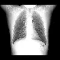 Fibroza - Cauze si simptome de fibroză pulmonară