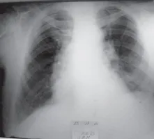 Fibroza - Cauze si simptome de fibroză pulmonară