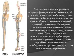 Plano-valgus picior deformare la adulți medicatie si simptome
