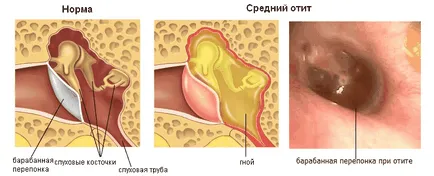 Последиците от възпаление на средното ухо при деца и възрастни - които могат да бъдат усложнения