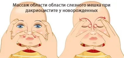 Закупорка (непрохідність) слізного каналу у новонароджених (закупорка) Закупорка (непрохідність) слізного каналу у новонароджених