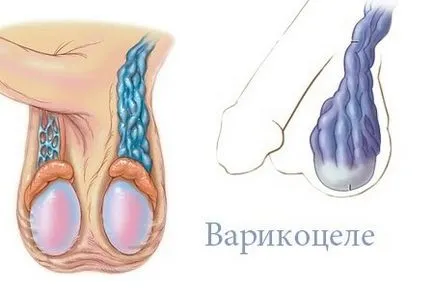Многократното варикоцеле рецидив след операция
