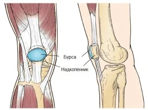 Prepatellyarny bursitis és annak kezelése