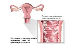 Причини и лечение на тежки разряд при жените