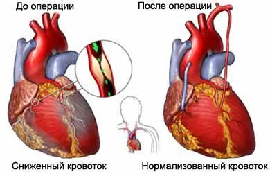 Причини и лечение на болки в сърцето си, дава на скапула