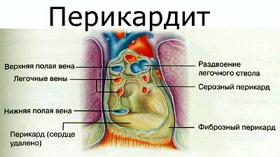 Причини и лечение на болки в сърцето си, дава на скапула