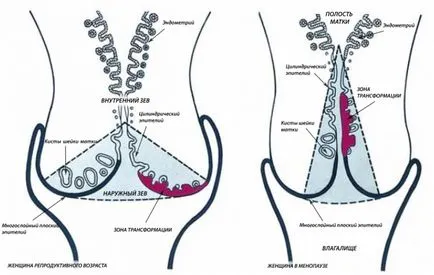Причини за възникване на шийката на матката ерозия в раждали и да раждали жени