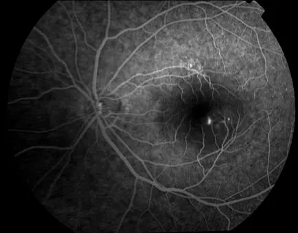 Cauzele pete, puncte negre și musculițe în ochi