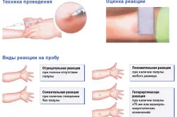 Vaccinarea împotriva regulilor de vaccinare tuberculozei, contraindicații și posibile complicații