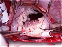 Изкуствена клапа на сърцето - видове протези