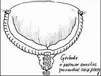 proteze valvulare cardiace - tipuri de proteze