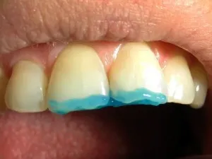 Dental Gravură - o procedură în stomatologie, Everestul dentare în St. Petersburg