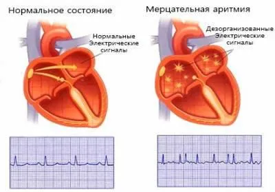 Pulse и сърдечната честота е скоростта, при възрастни и деца - живота ми