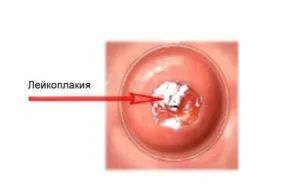 Rádióhullámos kezelése nyaki leukoplakiának előnyeiről és hátrányairól